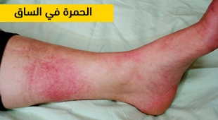 Magazine الحمرة في الساق