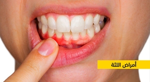 Magazine أمراض اللثة
