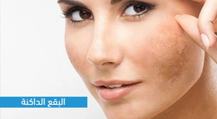 Makaleler البقع الداكنة