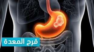 Makaleler قرح المعدة