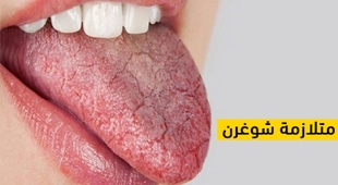 Magazine متلازمة شوغرن