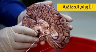 Magazine الأورام الدماغية