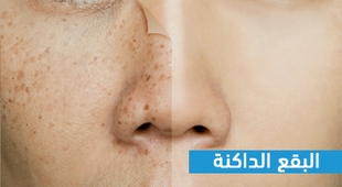 Magazine البقع الدكنة