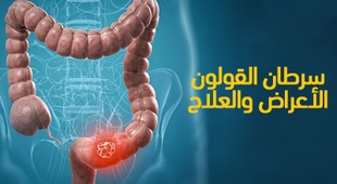 Magazine سرطان القولون : الأعراض والعلاج