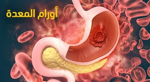 Magazine أورام المعدة