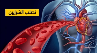 Magazine تصلب الشرايين