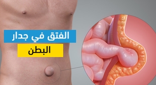 Magazine الفتق في جدار البطن