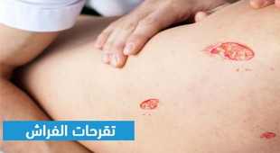 Makaleler تقرحات الفراش