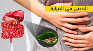 Magazine الحصى في المرارة