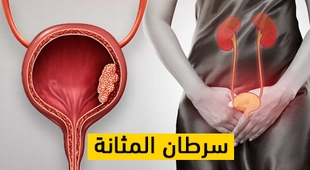 Magazine سرطان المثانة
