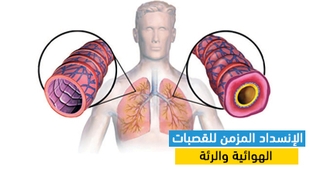 Magazine الإنسداد المزمن للقصبات الهوائية والرئة