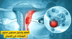 Makaleler العقم وتحليل مستوى مخزون البويضات في المبيض