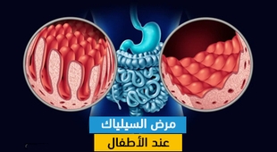المجلة الطبية مرض السيلياك عند الأطفال
