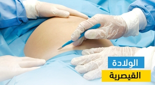 Makaleler الولادة القيصرية