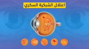 Makaleler اعتلال الشبكية السكري