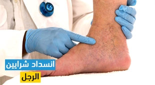 Magazine انسداد شرايين الرجل