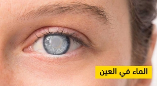 Makaleler الماء في العين