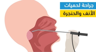 Magazine جراحة لحمات الأنف والحنجرة