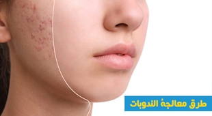 المجلة الطبية طرق معالجة الندوبات