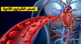 Makaleler تصلب الشرايين التاجية