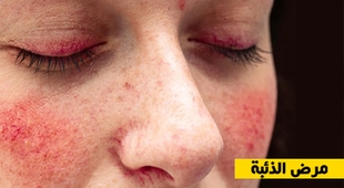 Makaleler مرض الذئبة