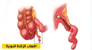 Magazine التهاب الزائدة الدودية