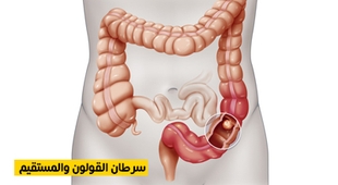 Magazine سرطان القولون والمستقيم