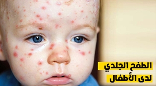 Magazine الطفح الجلدي لدى الأطفال