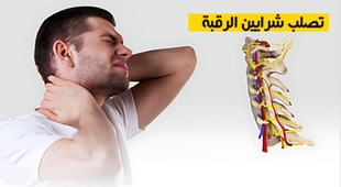 Magazine تصلب شرايين الرقبة