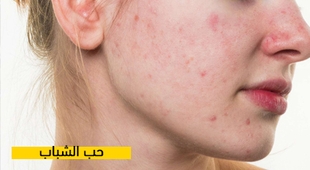 Makaleler حب الشباب