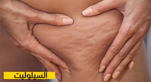 المجلة الطبية السيلوليت