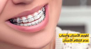 Makaleler تقويم الأسنان وأسباب عدم انتظام الأسنان