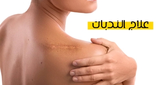 Magazine علاج الندبات