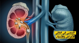 Magazine الحصى في الكلى : الأعراض والأسباب