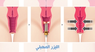 Magazine الليزر المهبلي