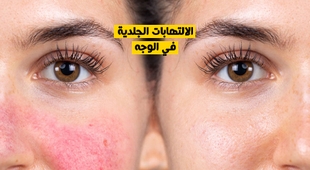 Magazine الالتهابات الجلدية في الوجه