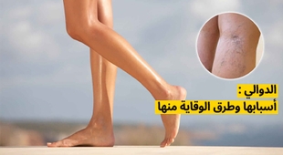 Magazine الدوالي : أسبابها وطرق الوقاية منها