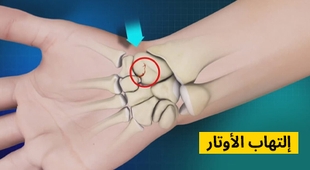 Makaleler التهاب الأوتار