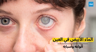 Makaleler الماء الأبيض في العين : أنواعه وأسبابه