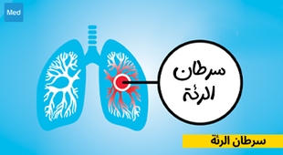 Makaleler سرطان الرئة