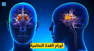 Magazine أورام الغدة النخامية