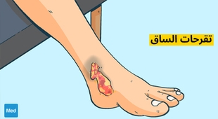 Makaleler تقرحات الساق