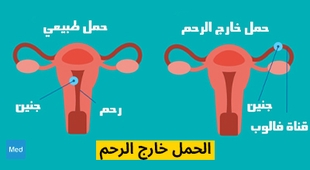 Magazine الحمل خارج الرحم