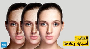 Magazine الكلف : أسبابه وعلاجه