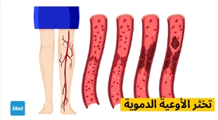 Magazine تخثر الأوعية الدموية