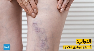 Magazine الدوالي: أسبابها وطرق علاجها