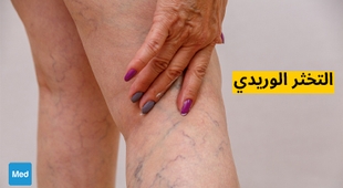 Magazine التخثر الوريدي