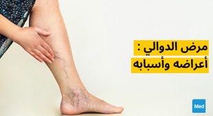 Magazine مرض الدوالي : أعراضه وأسبابه