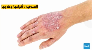 Magazine الصدفية : أنواعها وعلاجها