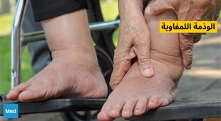 Magazine الوذمة اللمفاوية